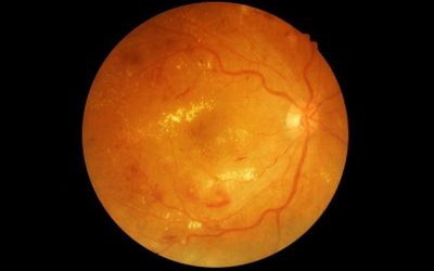 What is Diabetic Retinopathy?