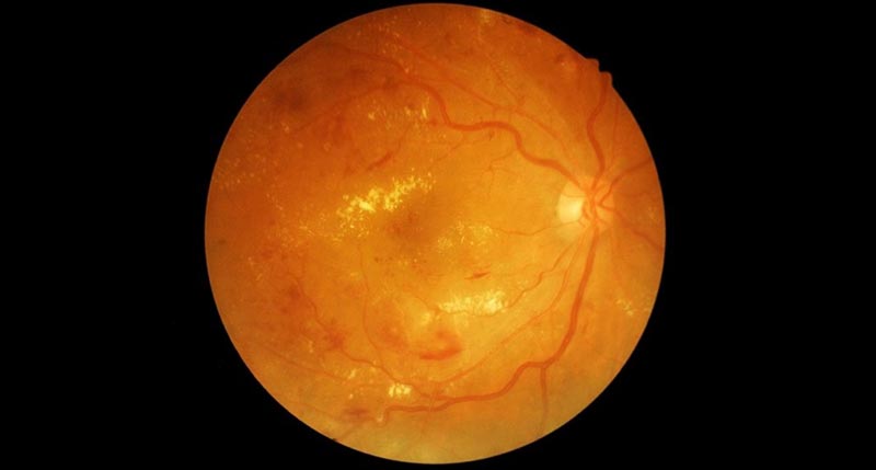 What is Diabetic Retinopathy?